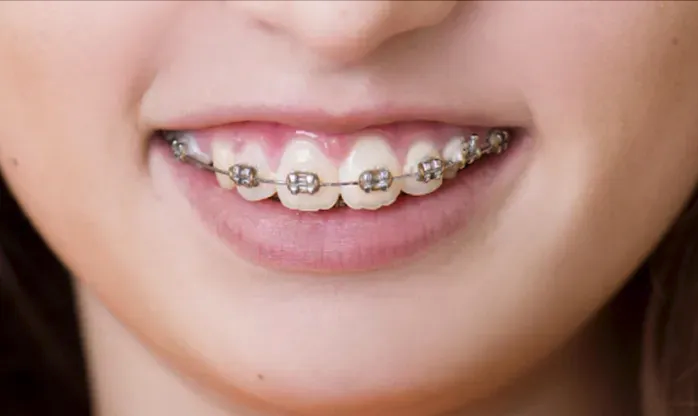 Children's braces close-up