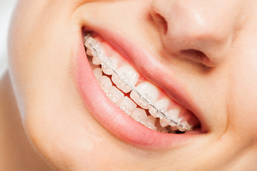 Clear and ceramic braces