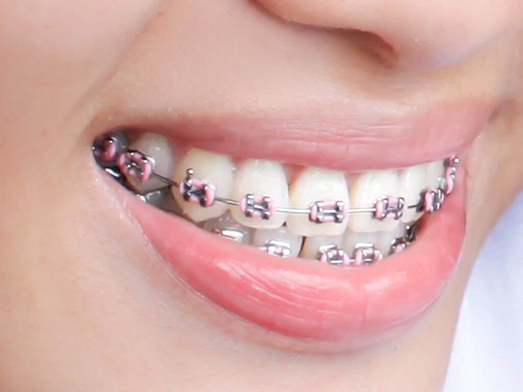 Traditional braces at Cotter Orthodontics